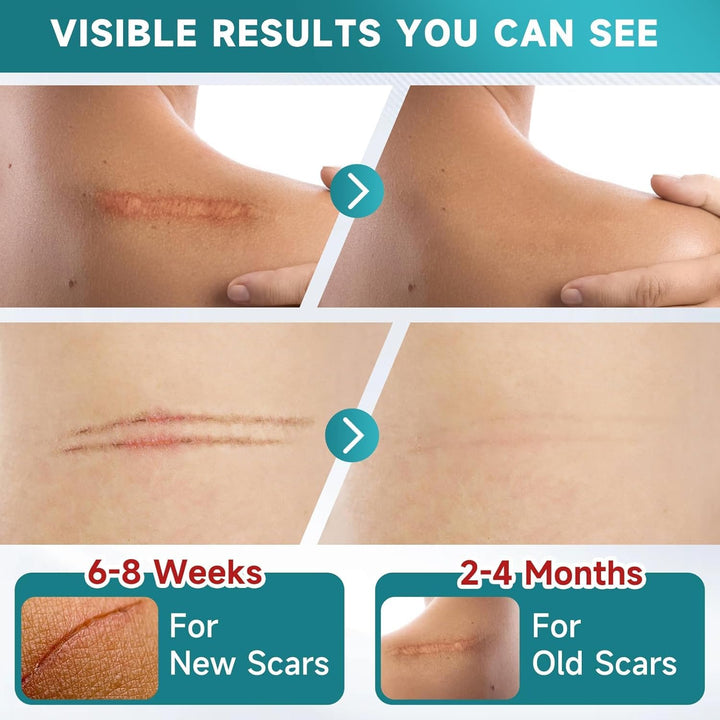 Silicone Scar Sheet (TR-204)
