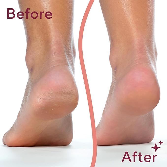 Electric Deadskin Remover For Feet